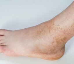 Пигментация кожи на ногах: причины и методы избавления